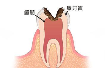 C3：神経にまで達した虫歯